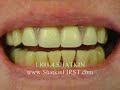 Mini Dental Implants - Bridge and Crown Compilation I