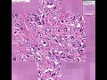 Histopathology Esophagus--Adenocarcinoma