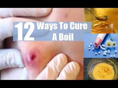 how to cure a boil