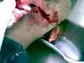 CIRUJIA DE EXTRACCION DE BALA