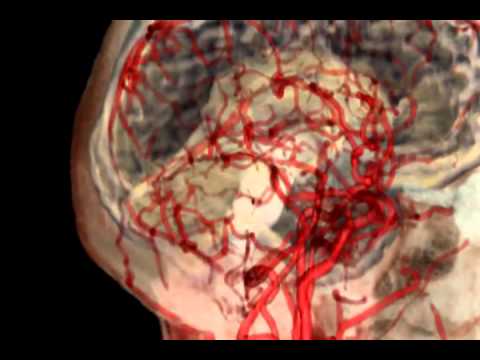 how to treat embolism