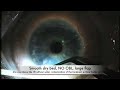 Ziemer LDV; The advancement of Zlasik!