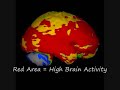 Hyperbaric Oxygen Therapy for Neurological Conditions Hyperbaric Oxygen Therapy for Neurological Conditions