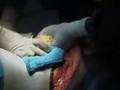 Bauchdeckenplastik Bauchhautstraffung Bauchdeckenstraffung Bauchstraffung NRW tummy tuck