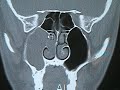 The endoscopic removal of a choanal polyp The endoscopic removal of a choanal polyp