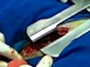 Lobectom�a veterinaria 2da parte