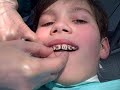 Getting My Braces! Stage 3 The Braces
