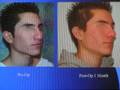 videos de Rhinoplasty or Nose job
