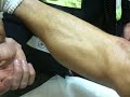 Muscular cramp of the calf after a marathon with fasciculations