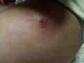 MRSA infection sicckkk
