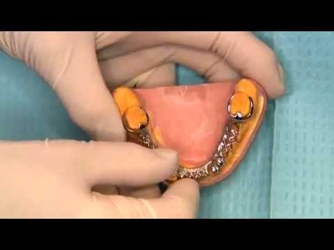 Removable Partial Dentures See video