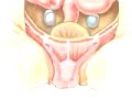 PreOp® Patient Education Hernia Repair Inguinal (Laparoscopic) 1