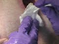 Pilonidal Excision 1 Week Post-Op
