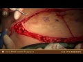 Suggestions On How To Go About Aesthetic Surgery http://www.youtube.com/watch?v=XmU9GdotSqk