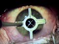 LASIK Eye Surgery Part 1