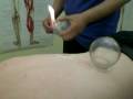 videos de Cupping Therapy Treatment - Traditional Chinese Medicine