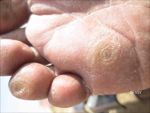 how to dissolve foot calluses