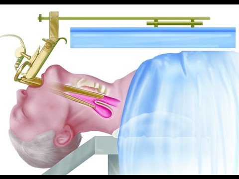 Zenker's Diverticulum Surgery - Endoscopic Staple Diverticulostomy