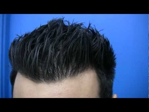 how to get a free hair transplant