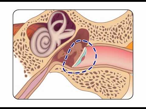 how to treat otitis media in adults