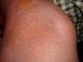 テラ日焼けに注意