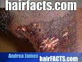 Laser Hair Removal Injury to Dark Skin Laser Hair Removal Injury to Dark Skin