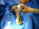 if you work a lot on a computer, you may have felt it -- pain and tingling in your hands and wrists. it could be carpal tunnel syndrome. now a new surgical technique may offer relief -- with less downtime. watch our video featuring dr. charles day.