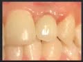 entrevista dR Rubin sobre casos de implantes,protese,clareamento e tudo que diz respeito a estética tratamento dentário Programa exame médico
