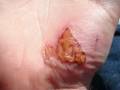 The healing process