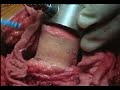Hip Resurfacing (Birmingham ) Surgery- Vijay C Bose_Part 3 Hip Resurfacing (Birmingham ) Surgery- Vijay C Bose_Part 3