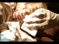 Cambria's Cyst Removal.wmv