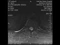 MRI benign tumor Benign Tumor