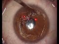 Operacion ojo izquierdo: PRK Operacion ojo izquierdo: PRK