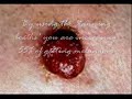 Skin cancer (Melanoma) PSA Skin cancer (Melanoma) PSA