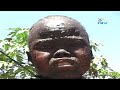 Boy Suffering From Mysterious Skin