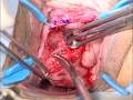 Excision of Transvaginal Mesh Extrusion
