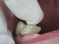 Loose tooth