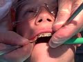 Getting My Braces! Stage 4 Expander Coming Off