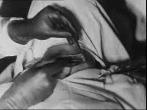 how to cure goiter disease