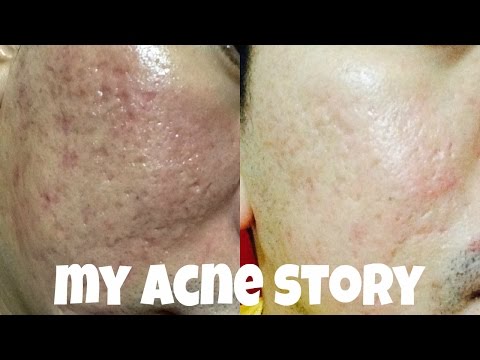 how to use a dermaroller for acne scars