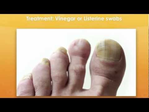 how to cure yellow nails