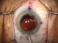 Cataract Surgery-Toric IOL Exchange by re-folding, Pt 1 of 2