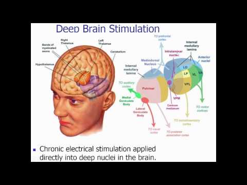 Epilepsy Webinar – Dr. Eric Segal, Neuromodulation in Epilepsy