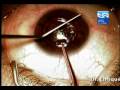 queratocono Video Cirugia (keratoconus, Keraring)