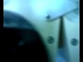 Cirugia Ojo Pterigion Pterygium resection eye Surgery