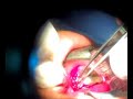 Cirugia Ojo Pterigion Pterygium resection eye Surgery