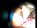 Cirugia Ojo Pterigion Pterygium resection eye Surgery