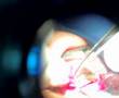 Cirugia Ojo Pterigion Pterygium resection eye Surgery