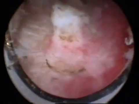 endometrium - Endometrial resection and ablation versus hysterectomy for heavy menstrual bleeding Destruction of endometrial tissue by either TCRE (transcervical resection...