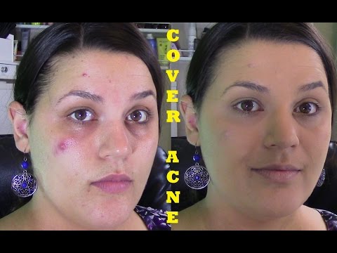 How to Cover Acne & Redness | Beautify Your Life